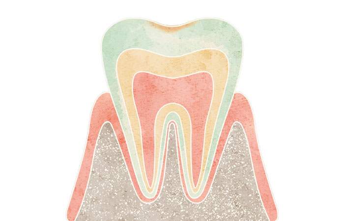初期むし歯（CO）