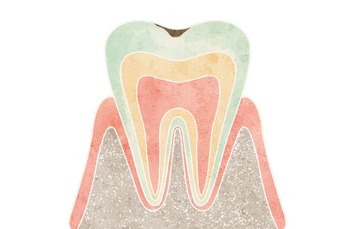 エナメル質のむし歯（C1）