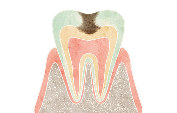 象牙質まで進行したむし歯（C2）