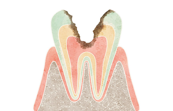 神経まで進行したむし歯（C3）