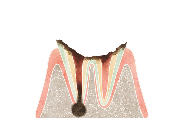 歯根だけ残ったむし歯（C4）