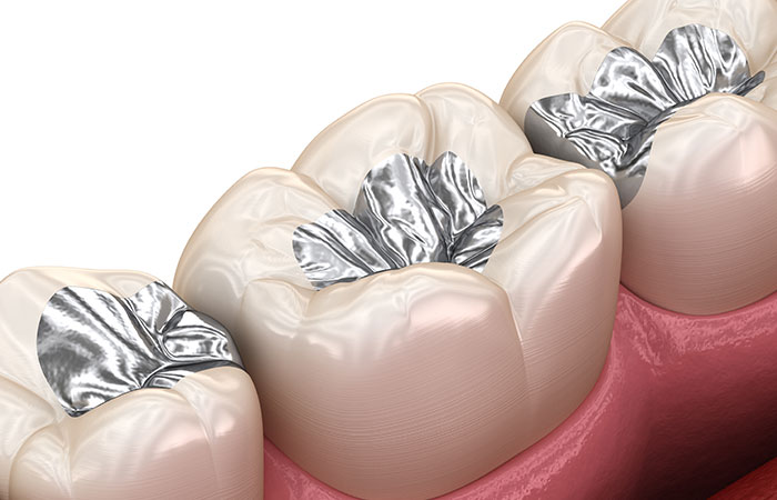 銀色の詰め物・被せ物