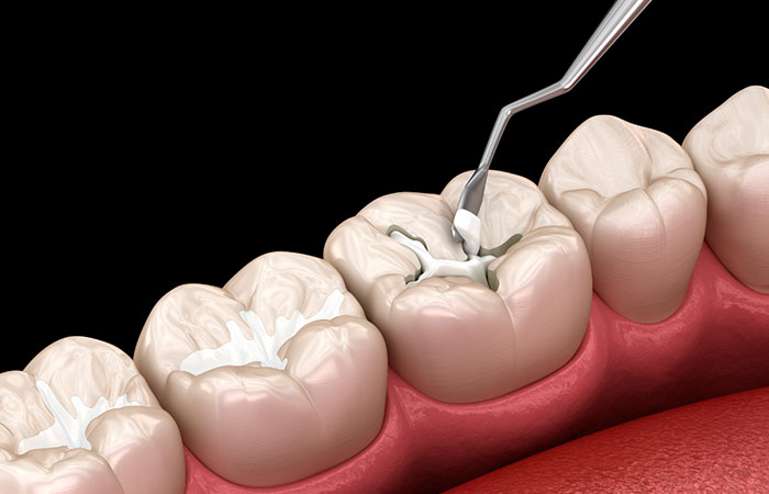 レジンの詰め物・被せ物