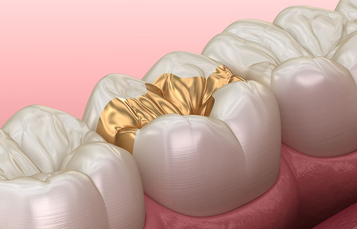 ゴールドの詰め物・被せ物