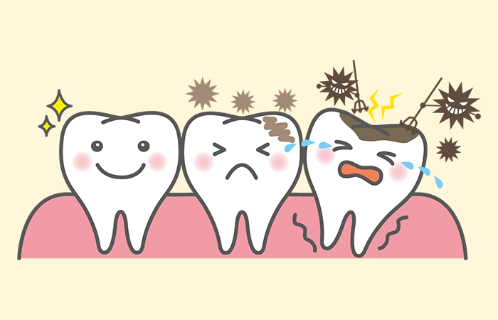 子どものむし歯の特徴