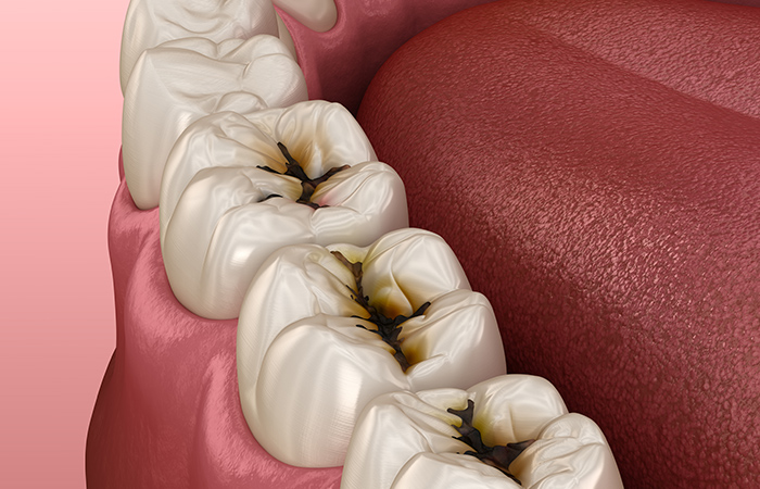 永久歯もむし歯になりやすくなる