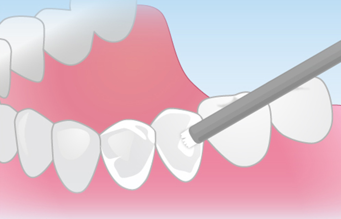 フッ素(フッ化物)塗布