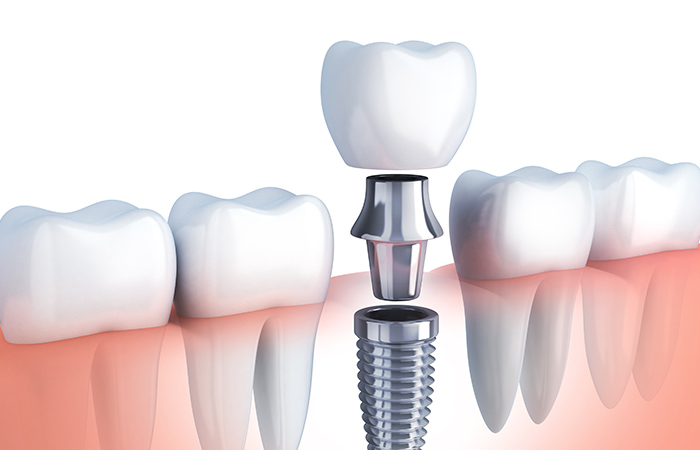 健康な歯への影響がない（他の歯への影響）
