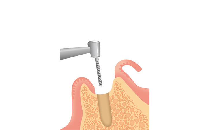 インプラント体の埋入