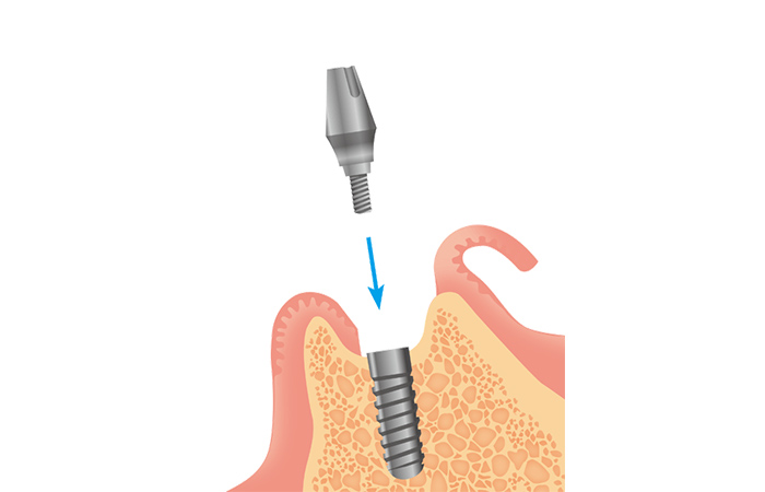 アバットメントの装着