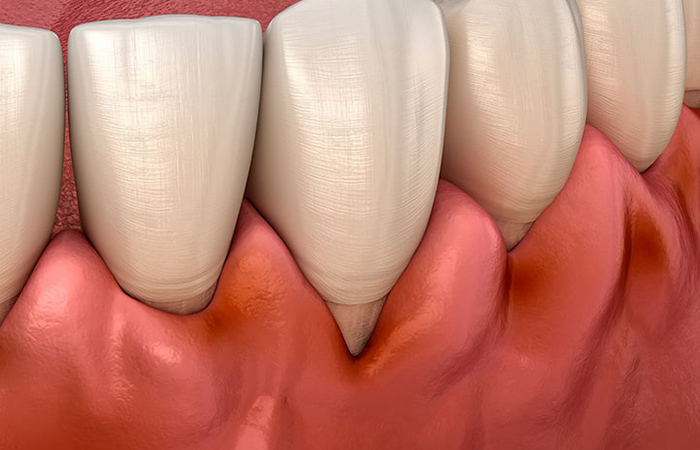 インプラント周囲炎