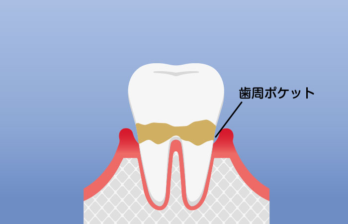 歯周炎（軽度）