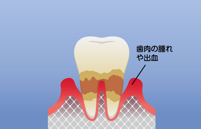 歯周炎（中度）