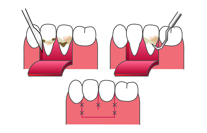 進行した歯周病の治療