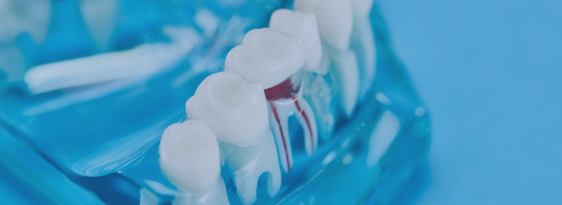 根管治療（歯内療法）