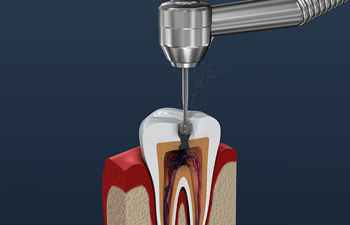 歯髄に達するまで歯を削る