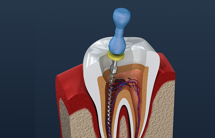 炎症を起こした歯髄の除去