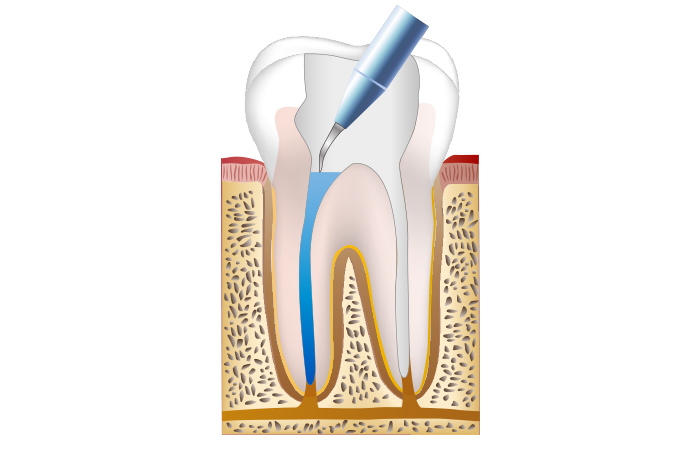 根管内の清掃と消毒