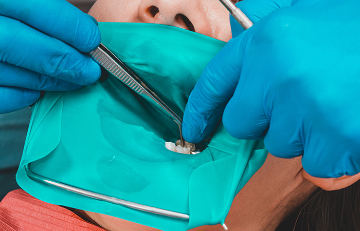 ラバーダムを使った治療