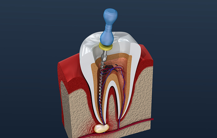 根管内の充填剤や感染組織の除去