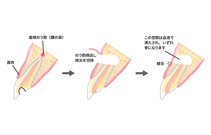 外科的歯内療法（歯根端切除術）